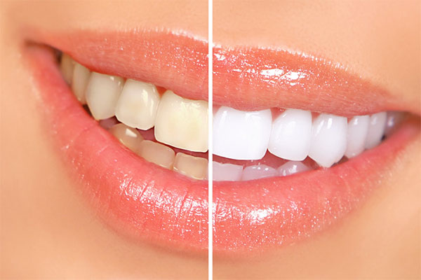 diş beyazlığı